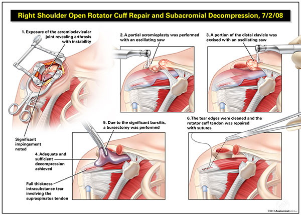 Torn rotator cuff with surgery and neck and back soft tissue injuries